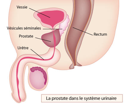 Cancer de la prostate: pourquoi il est particulier