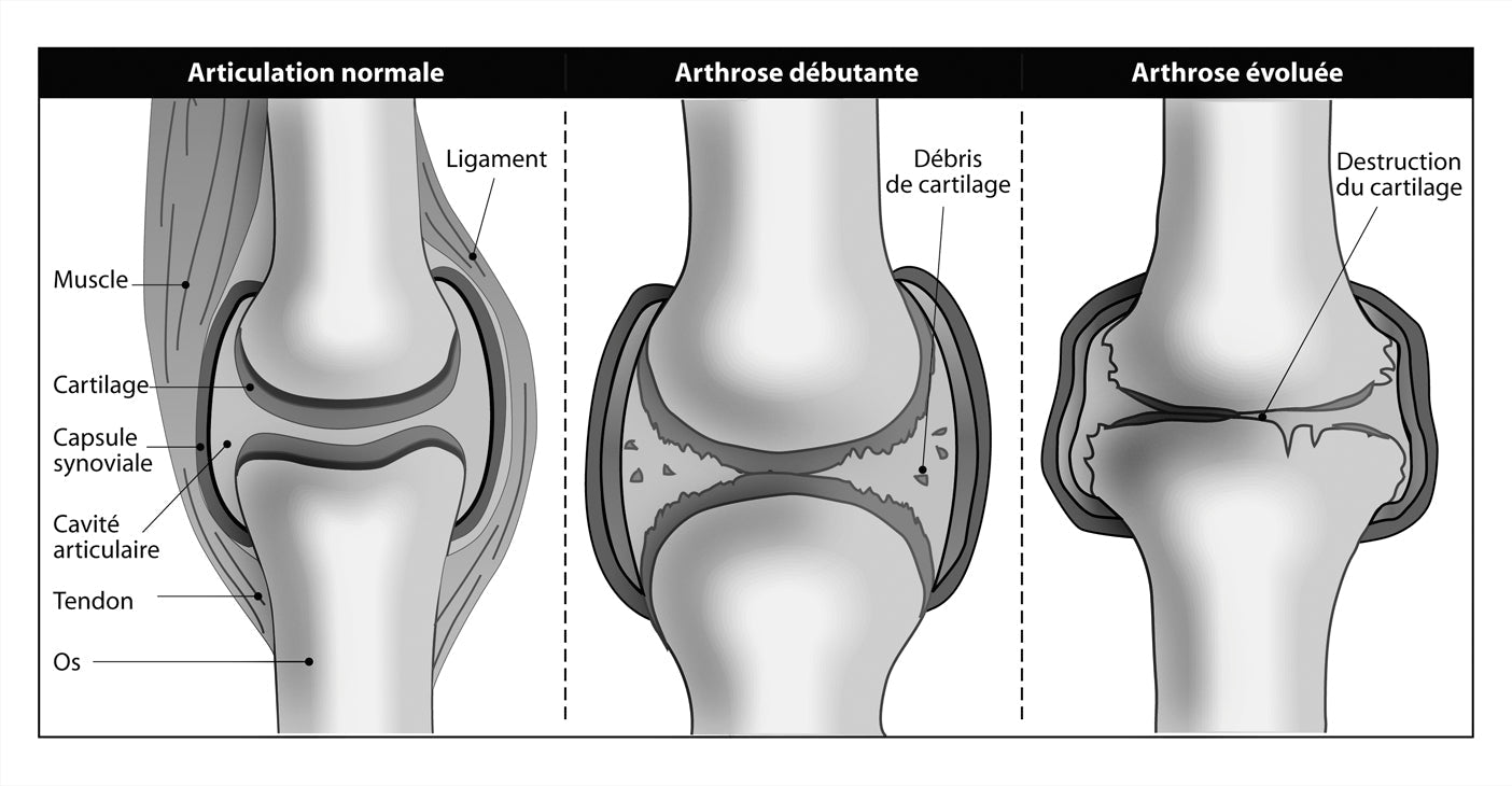 Arthrose : comment le cartilage est détruit