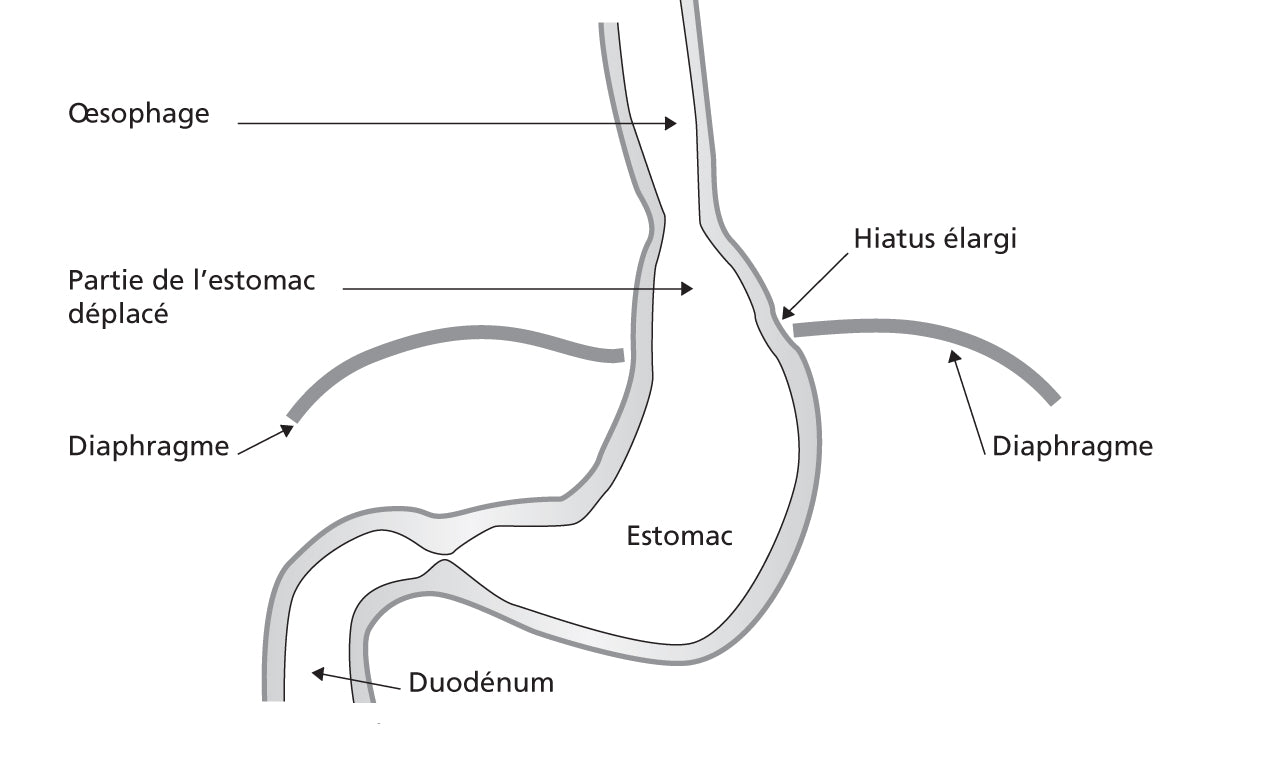 Qu'est-ce qu'une hernie hiatale?