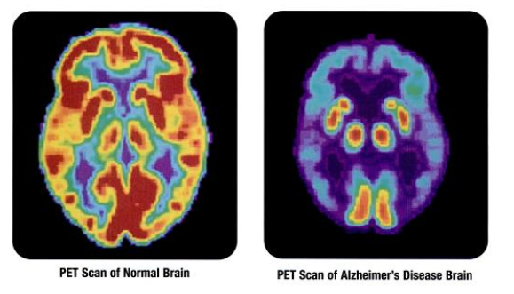 Alzheimer : un diabète de type 3?